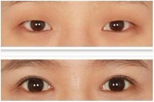 韩式微创双眼皮手术后会有后遗症吗