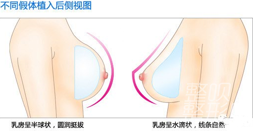 做假体隆胸要多少钱呢假体隆胸的价格多少