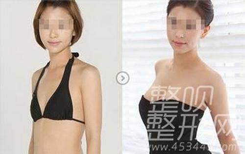 广州南方医院巨乳缩小手术怎么样?多少钱?