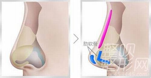 做自体软骨隆鼻手术的果怎么样?多少钱?