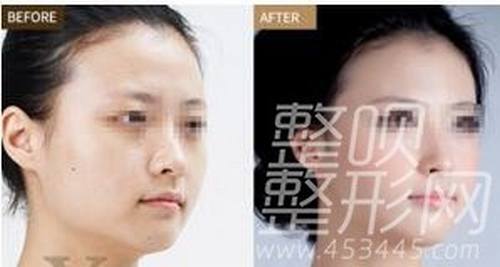 哪种方法丰太阳穴的*果更好呢?