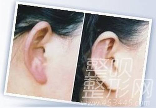 耳部再造手术的果好不好呢？