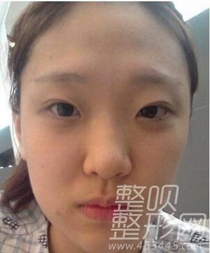 脸部自体脂肪移植3周后果
