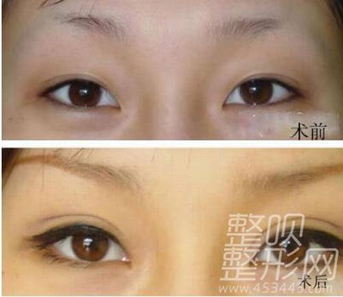 北京做双眼皮修复一般要多少钱?