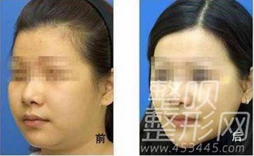 面部吸脂手术前要注意什么?