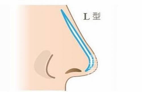 鼻头大鼻翼宽需要通过综合隆鼻手术来解决问题