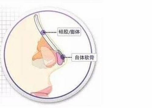 鼻头大鼻翼宽需要通过综合隆鼻手术来解决问题